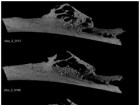 Monge J, Kricun M, Radovčić J, Radovčić D, Mann A, et al. (2013) Fibrous Dysplasia in a 120,000+ Year Old Neandertal from Krapina, Croatia. PLoS ONE 8(6): e64539. doi:10.1371/journal.pone.0064539